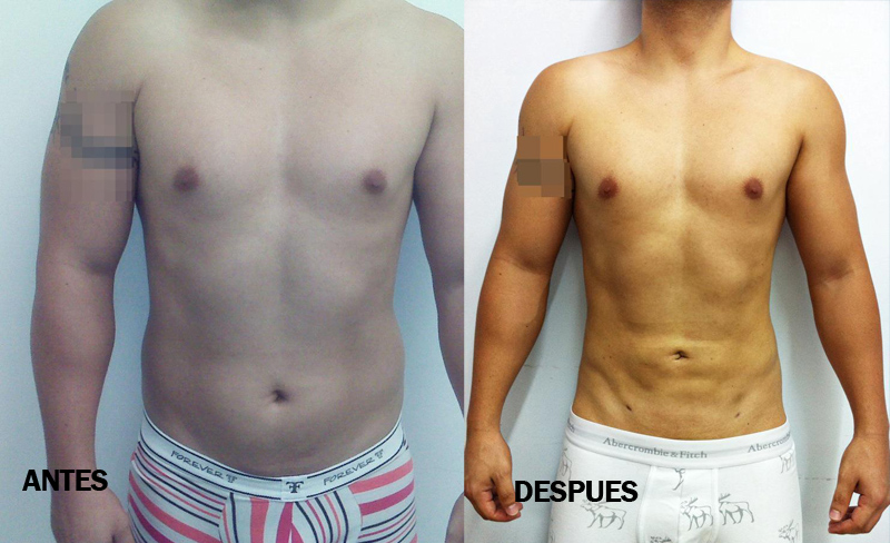 Antes y después de Slim Láser