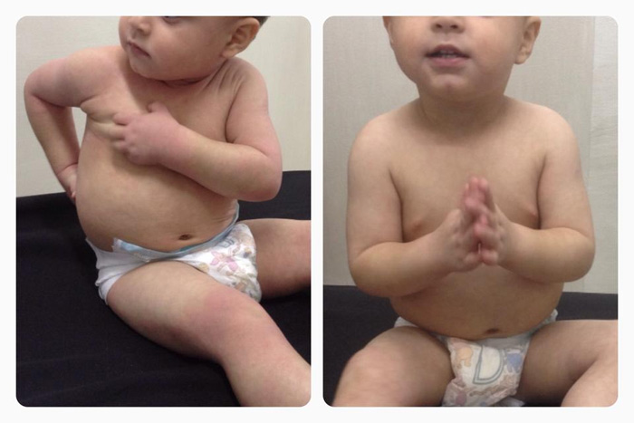 Podemos mejorar los niños con Dermatitis Atopica muy rápido