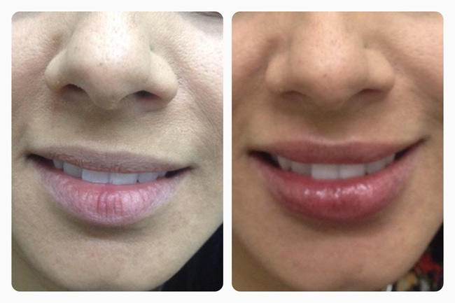 Dale volumen y forma a tus labios