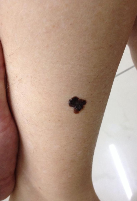Melanoma Maligno