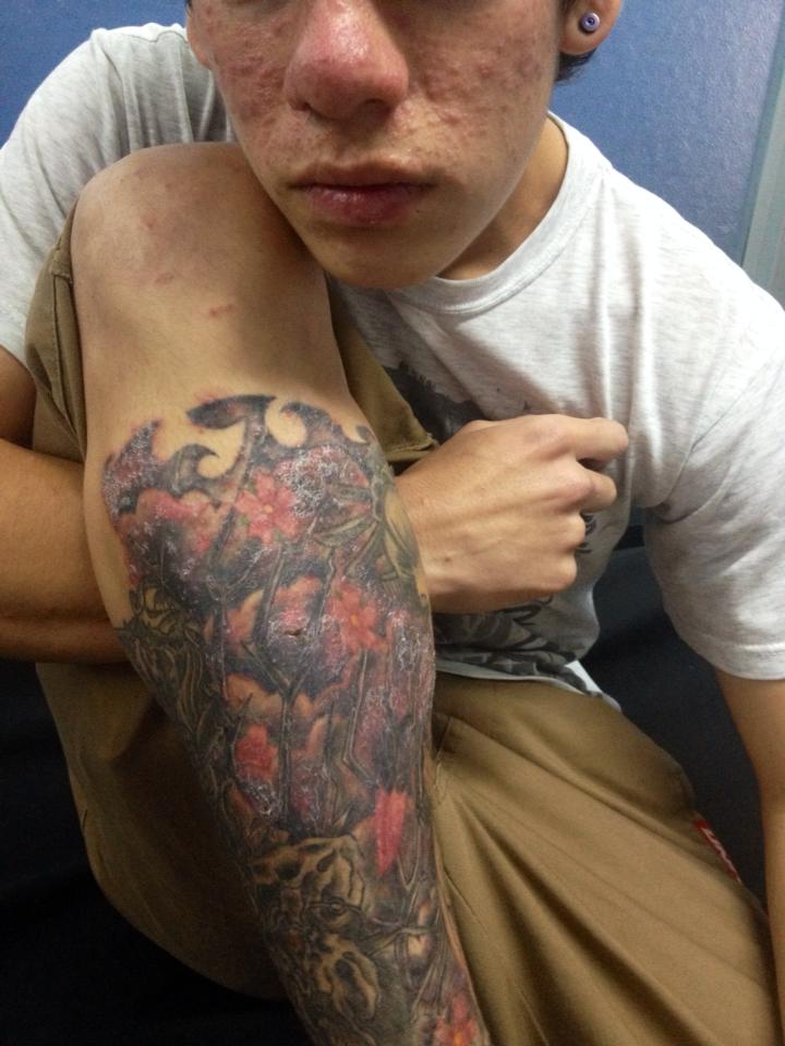 Paciente con reacción generalizada al pigmento de su nuevo tatuaje