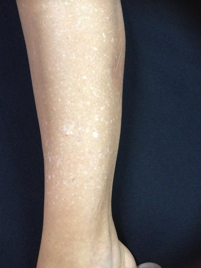 Hipomelanosis Gutata