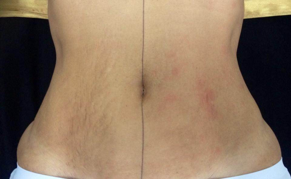 Tensado de abdomen