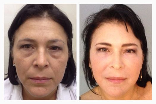 REJUVENECIMIENTO FACIAL SIN CIRUGÍA