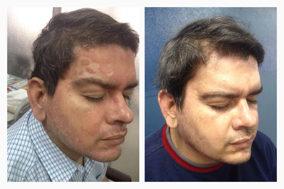 Trata tu psoriasis nosotros podemos mantenerte controlado