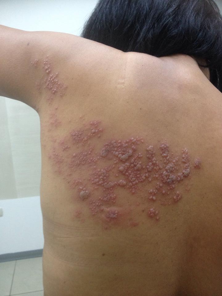 Herpes Zoster una enfermedad viral que afecta una trayecto nervioso solo en una mitad del cuerpo