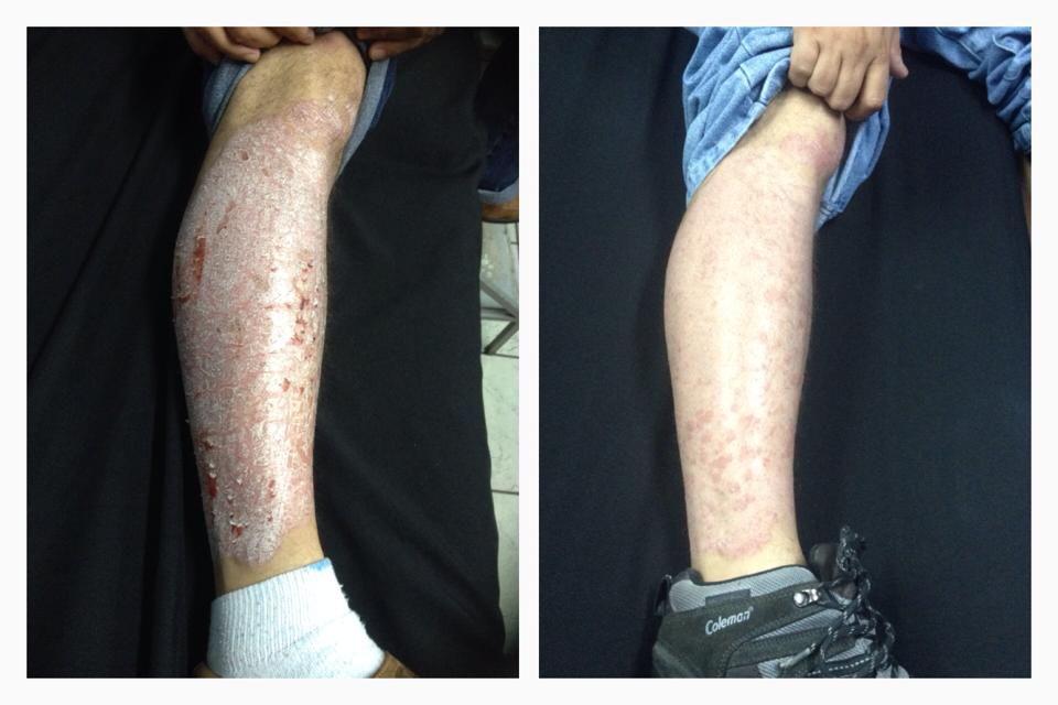 La Psoriasis se puede controlar busca tu dermatólogo el sabe bien que hacer