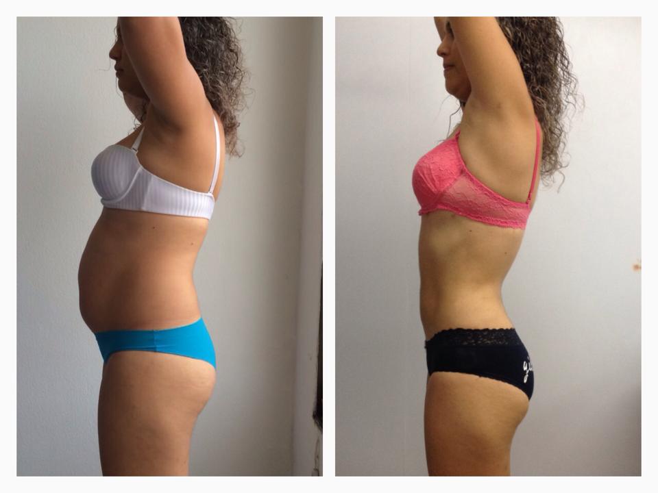 Slim Laser… un procedimiento creado y exclusivo del Dr Eric Rojas