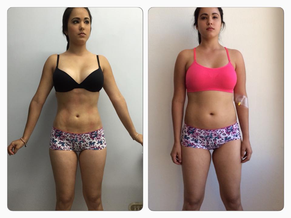 A un mes del (SLIM LASER DR. E ) simplemente increíble el cambio…
