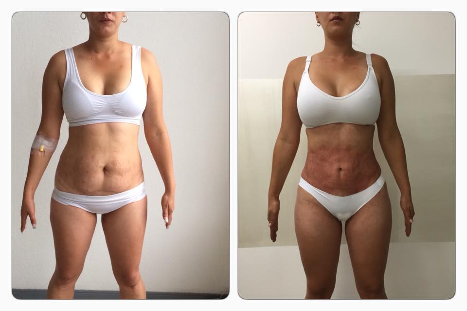 En tratamiento aun para disminuir las estrías por eso el color del abdomen