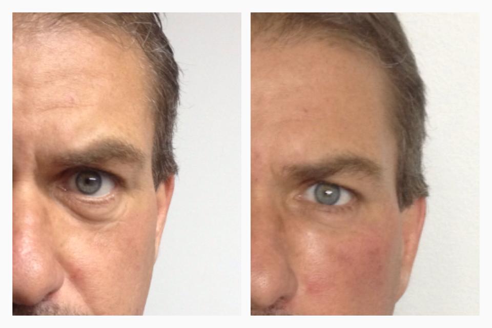 Elimina tus ojeras con nosotros