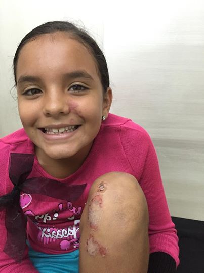 IMPETIGO CONTAGIOSO