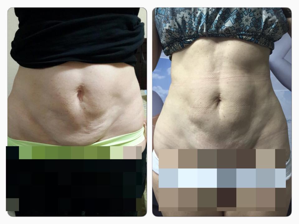 Esa piel sobrante en tu abdomen podemos retraerla con nuestro nuevo láser FOTONA