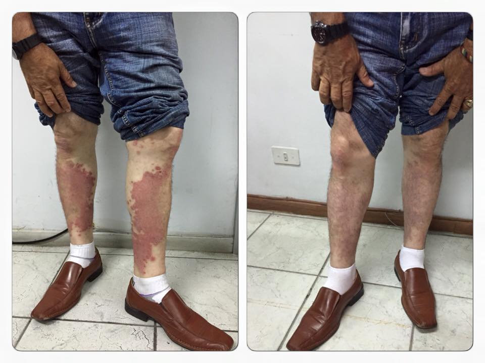 PSORIASIS A UN MES DE TRATAMIENTO