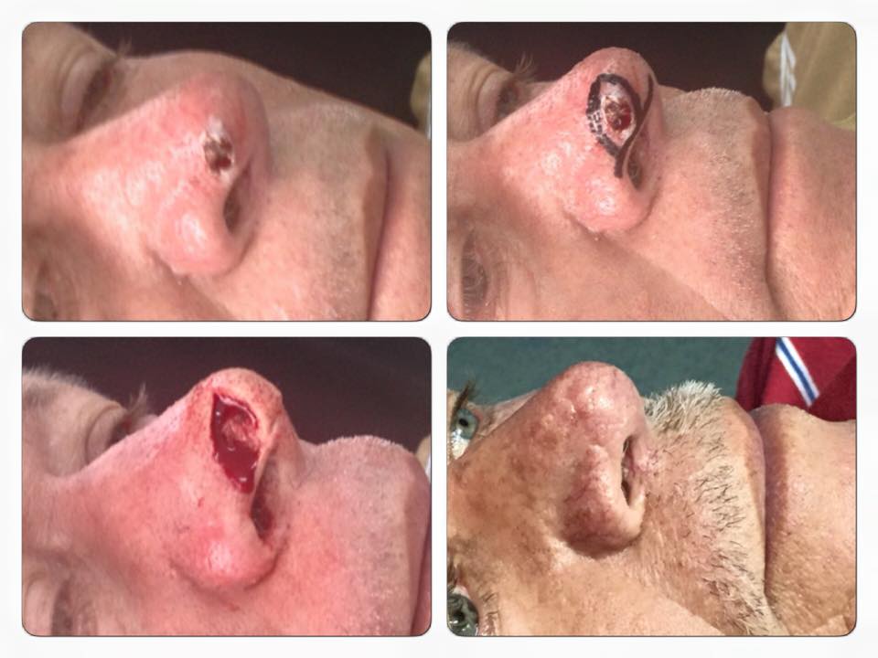 CARCINOMA BASOCELULAR