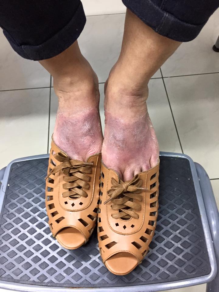 DERMATITIS DE CONTACTO
