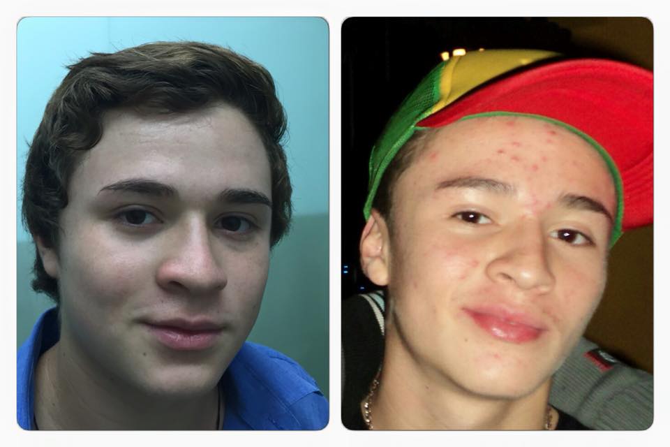 El acné de adolescente ya no debe de ser un problema