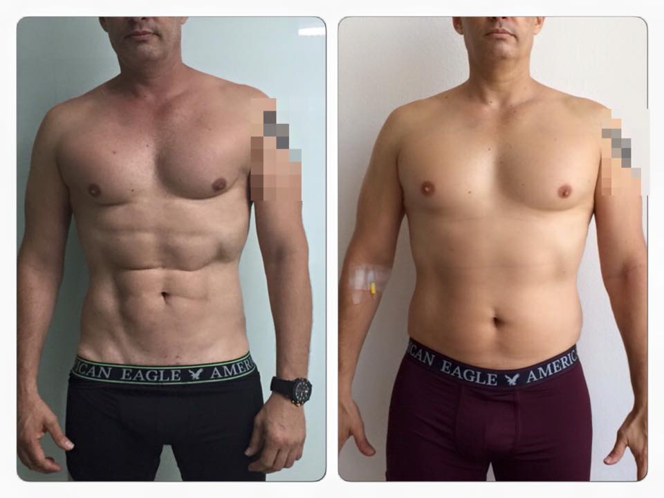 Esto es SLIM LASER del DR ERIC ROJAS es nuestra creación y exclusivo