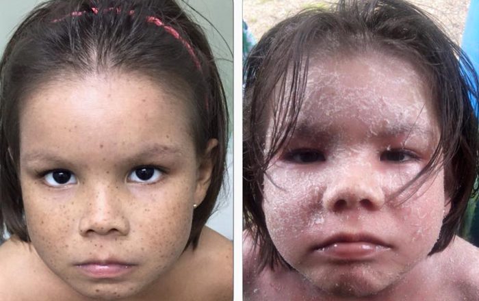 DERMATITIS ATOPICA SEVERA DESPUÉS DE 15 DIAS DE TRATAMIENTO