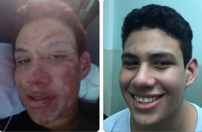 Después de una QUEMADA CON GAS LOGRAMOS MEJORAR LA PIEL