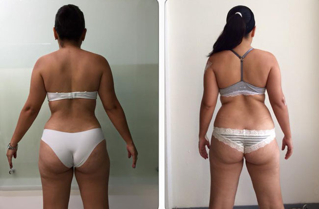 Cambia tu figura . NOSOTROS PODERMOS LOGRARLO CON NUESTRA TÉCNICA EXCLUSIVA SLIM LASER