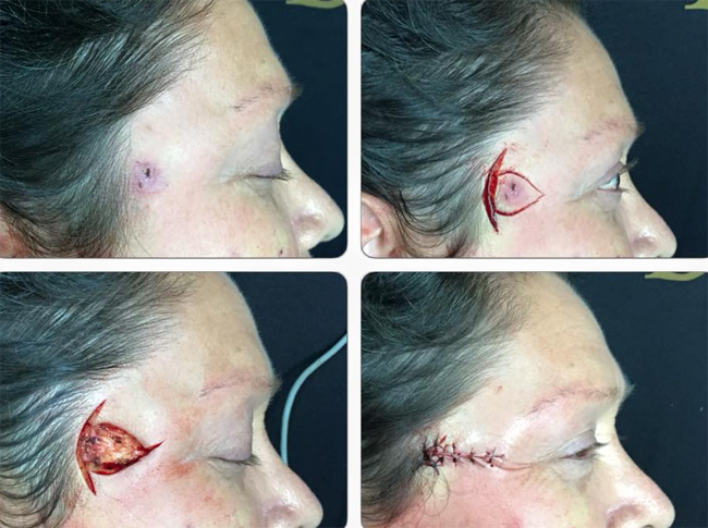 LA CIRUGIA DERMATOLÓGICA NOS PERMITE LA ELIMINACIÓN DE CASI TODO TIPO DE CÁNCER DE PIEL