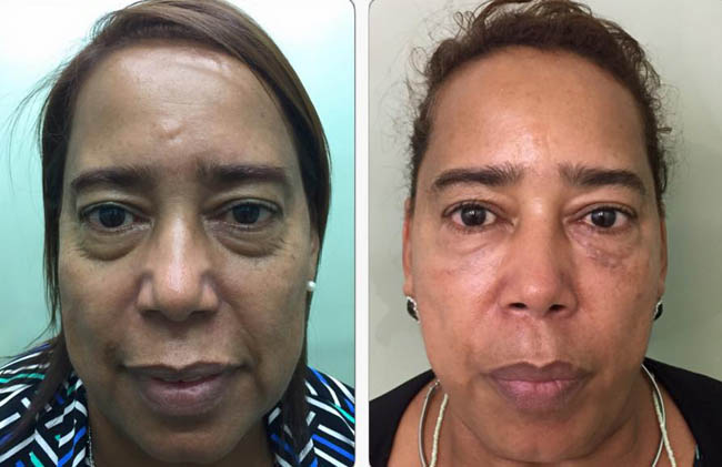 Tus OJERAS YA NO SON más UN PROBLEMA