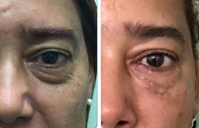TUS OJERAS DISMINUIRLAS CON NOSOTROS ES POSIBLE Y SIN CIRUGIA
