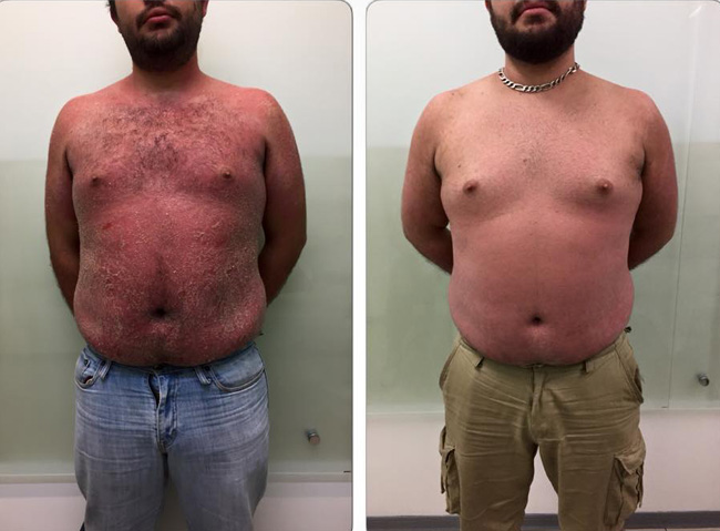 En una semana logramos mejorar un paciente con psoriasis severa.