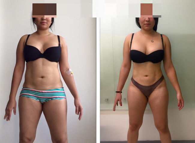 Nuestros cambios son sorprendentes tu también puedes mejorar tu figura de forma segura