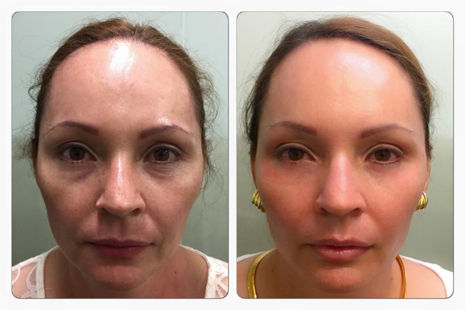 Feliz doña Sandra Castro con su refrescamiento facial y yo feliz con verla así de sonriente.