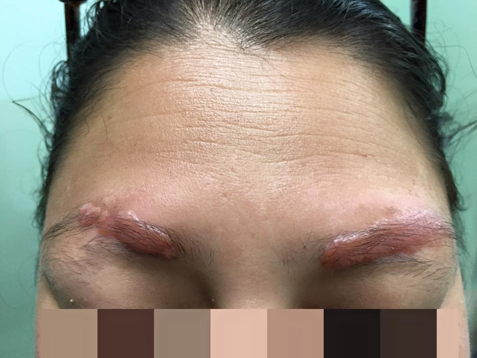Cicatriz Queliode posterior a micro pigmentación de cejas