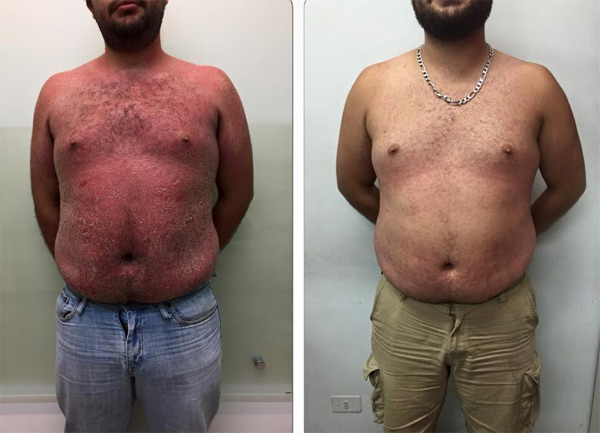 Casi dos meses después del tratamiento nuestro pacientes está controlado de su PSORIASIS