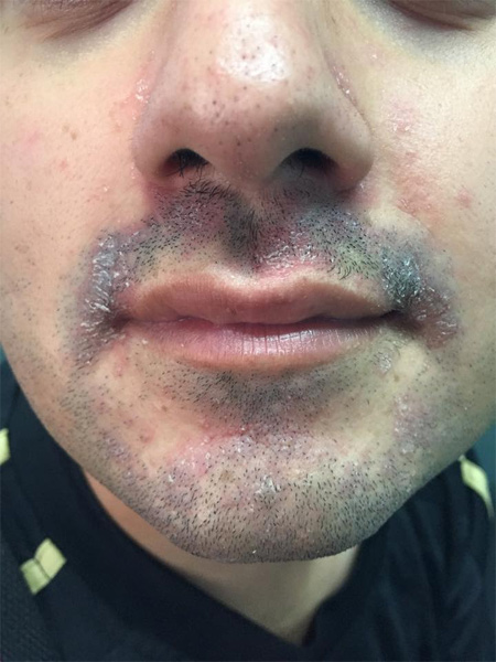 DERMATITIS SEBORREICA