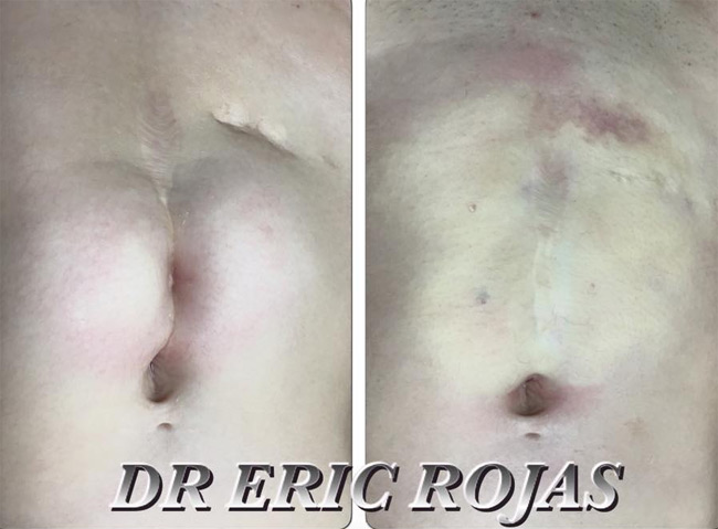 EN MENOS DE 5 minutos PUESDE MEJORAR ESAS CICATRICES QUE MARCAN TU ABDOMEN