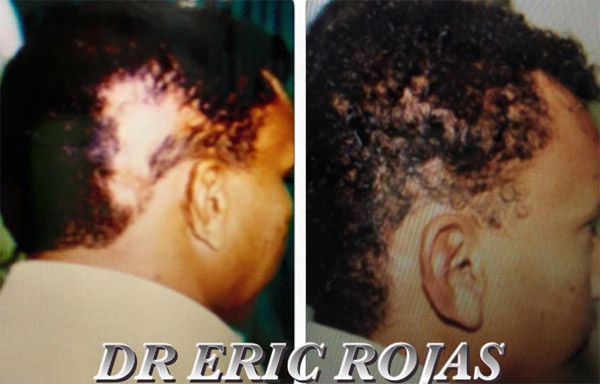 LAS ZONAS SIN CABELLO SEA LA RAZÓN QUE SEA SE PUEDEN REPOBLAR DE CABELLO Y ASÍ LUCIR UNA CABELLERA MAS NATURAL