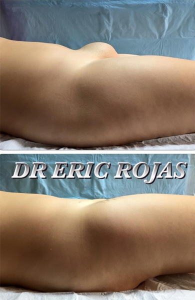 PUBIS PROMINENTE