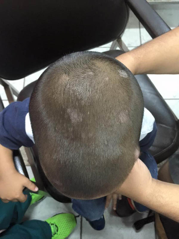 TIÑEA CAPITIS U HONGO DE LA CABEZA
