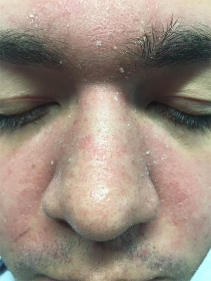 DERMATITIS SEBORREICA