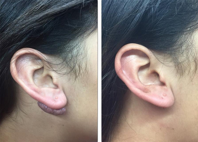 Queloide en la oreja