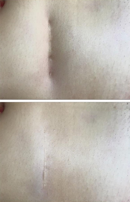 TU CICATRIZ YA NO SERÁ UN PROBLEMA EN TU ABDOMEN