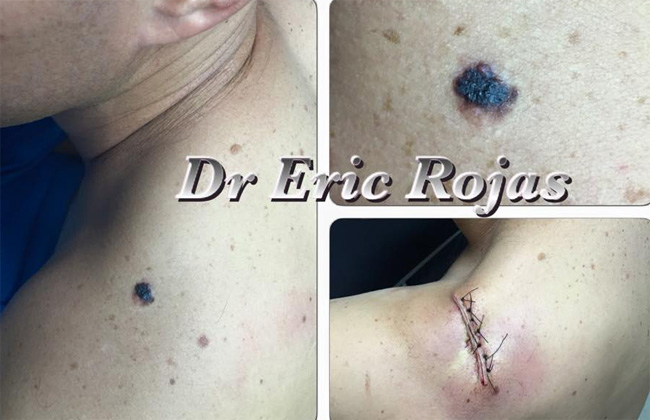MELANOMA MALIGNO …