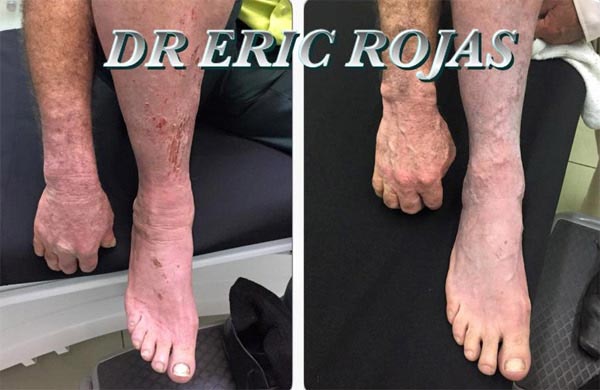 LAS DERMATITIS SE PUEDEN MEJORAR SOLO ES NECESARIO BUSCAR TU DERMATOLOGO
