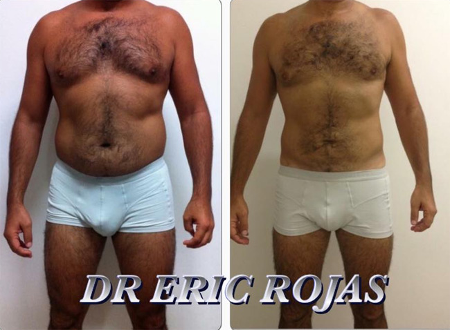 Si tu objetivo no es la MARCACIÓN ABDOMINAL sino solo disminuir el abdomen nosotros tenemos el procedimiento adecuado.