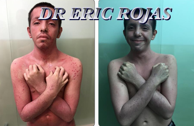DESPUÉS DE 17 AÑOS DE LUCHAR CON UNA DERMATITIS ATOPICA SEVERA.