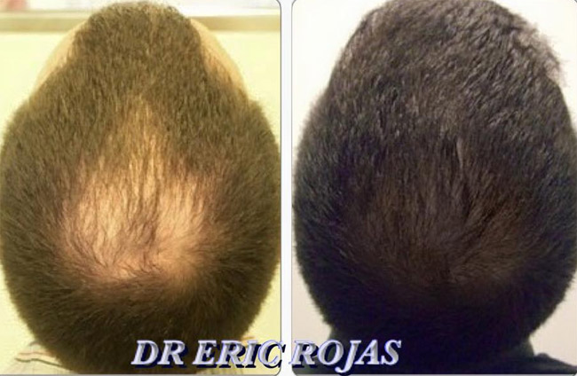 MICROIMPLANTE DE ALTA DEFINICIÓN DEL DR ERIC ROJAS