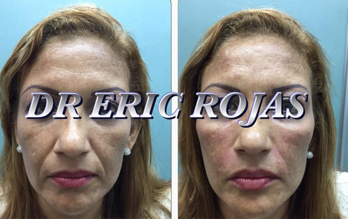 Elimina las líneas y surcos de tu rostro