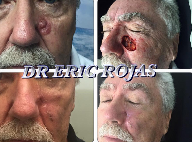 DERMATOLOGÍA QUIRÚRGICA NOS PERMITE REALIZAR TRATAMIENTOS PARA ELIMINAR LESIONES CANCERÍGENAS EN CUALQUIER PARTE DE TU PIEL