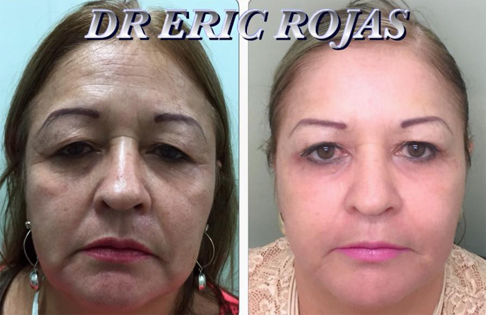 Rejuvenecimiento DR ERIC ROJAS cambia tu rostro y toda tu vida