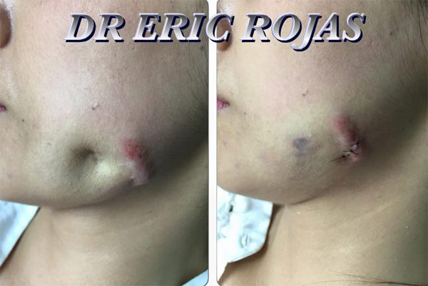 Paciente con cicatriz después de un abceso peridontal y un queloide post acné